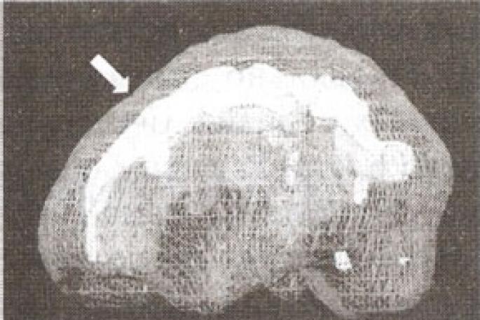 Girusul cingular - blogul Dr. Minutko Girusul cingular al funcțiilor creierului